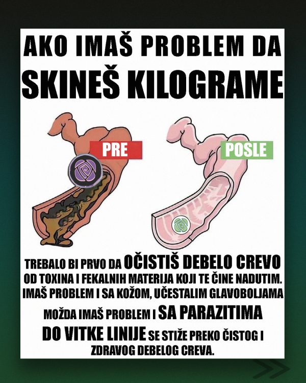 Ilustracija koja prikazuje razliku pre i posle čišćenja debelog creva – prirodna detoksikacija i podrška zdravlju creva uz Prim Rose