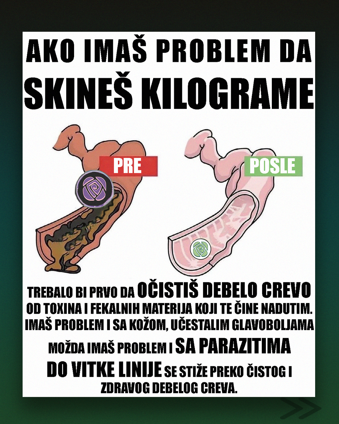 Ilustracija koja prikazuje razliku pre i posle čišćenja debelog creva – prirodna detoksikacija i podrška zdravlju creva uz Prim Rose